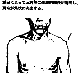 よく肩の脱臼をすると”くせ”になると言われますがなぜですか。
