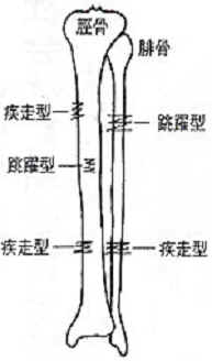 下腿の傷害で疲労骨折・過労性骨膜炎について教えてください。